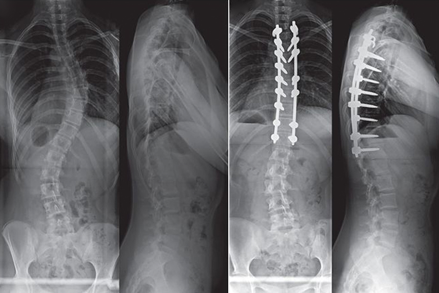 Skolyoz Cerrahisi Tedavi Seçenekleri ve Süreçleri